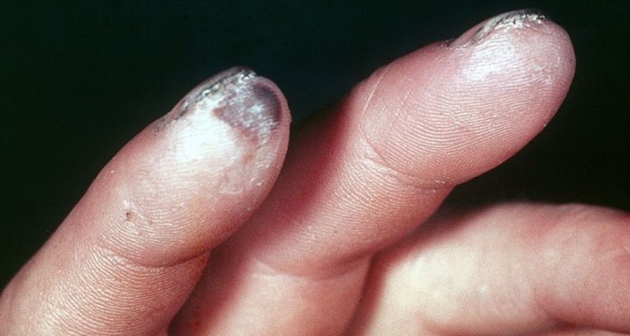 Dead fingertip tissues turning black after frostbite
